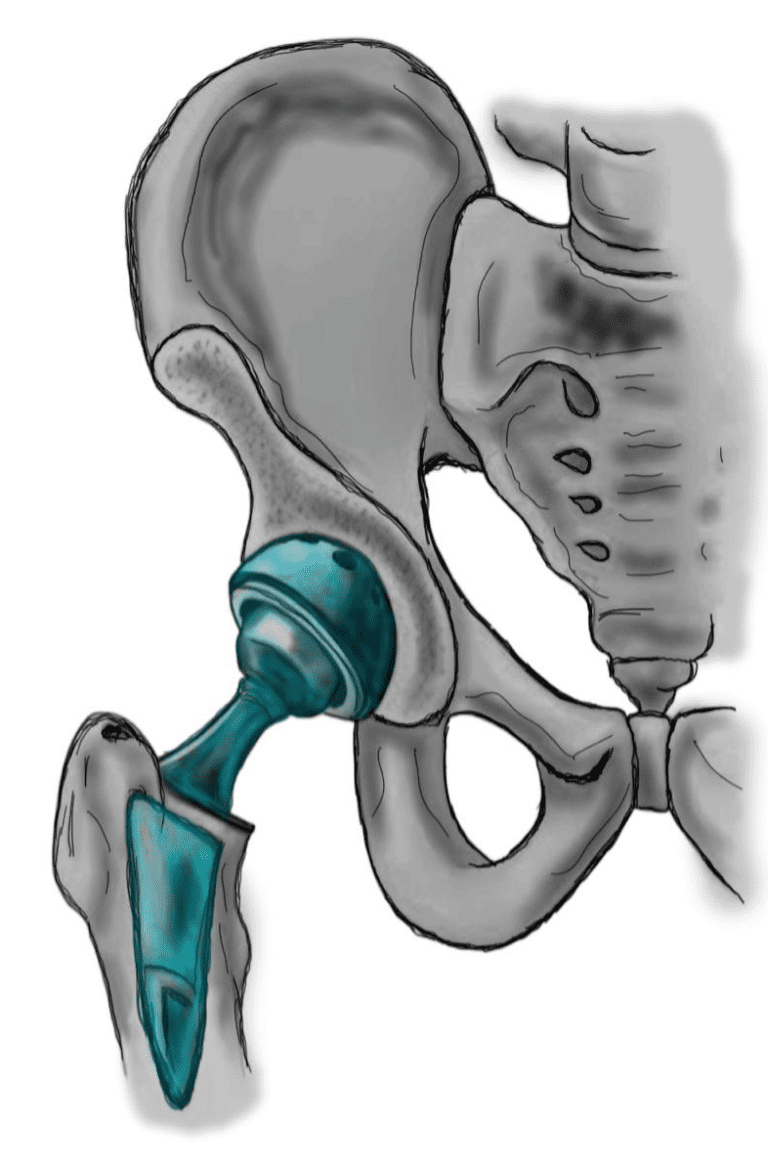 Minimalinvasive Hüft-TEP in Potsdam