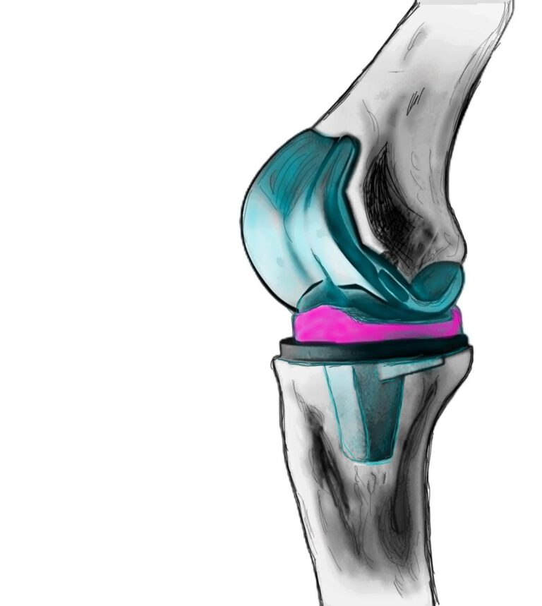 Künstliches Kniegelenk (Knie-TEP)