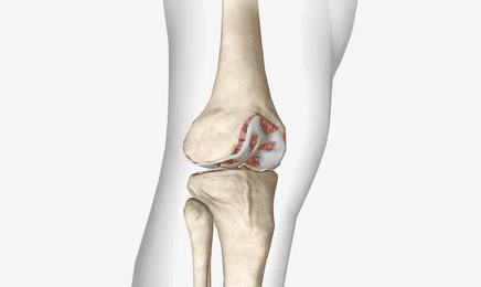 Rekonstruktive Knorpelchirurgie am Knie