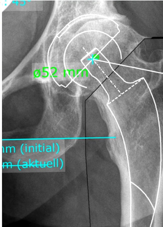 Kurzschaftprothese der Hüfte bei Hüftarthrose – Ratgeber Orthopädie Potsdam